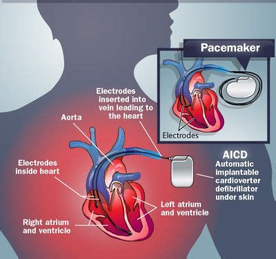 interference with icds and pacemakers